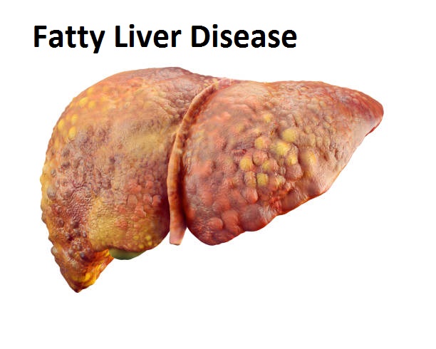 Fatty Liver Disease Explained: Causes, Symptoms, Treatments, and Prevention Tips