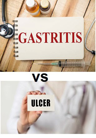 Difference between gastritis and peptic ulcer