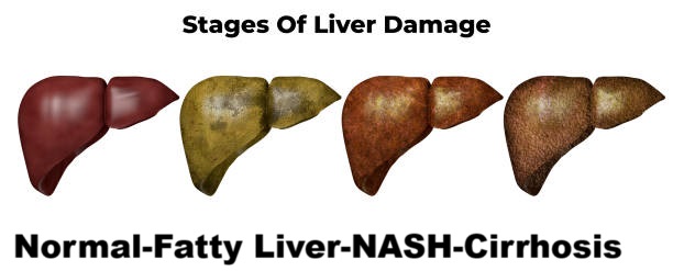 Can hepatitis C cause cirrhosis