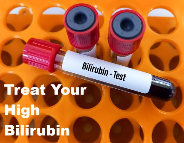 What Causes High Bilirubin in Adults? The Shocking Truth Behind Yellow Skin and Eyes