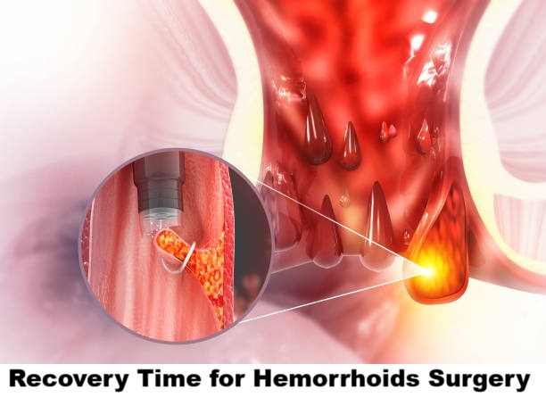 Hemorrhoids Surgery Recovery Time: Complete Guide for Patients
