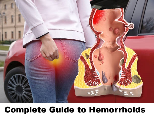 Hemorrhoids Relief: Complete Guide to Causes, Types, Symptoms, Treatment & Prevention