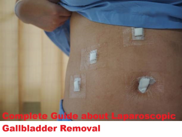 Laparoscopic Gallbladder Surgery Recovery Time