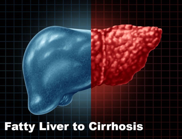 Liver Cirrhosis Foods to Avoid