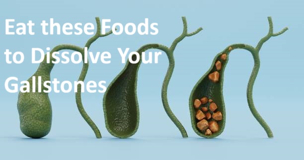 Foods that dissolve gallstones