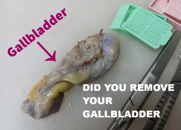 Life After Gallbladder Removal: Shocking Struggles and How to Overcome Them