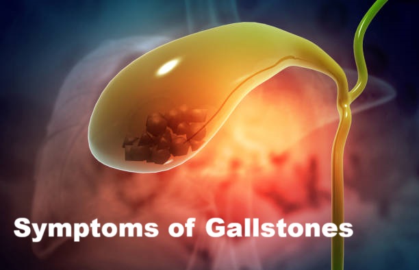 What are the common symptoms of gallstones