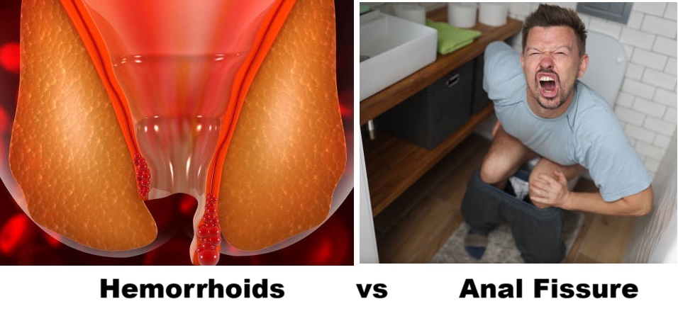 Anal Fissure vs Hemorrhoids: Shocking Differences, Causes & Fast Relief Options