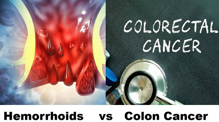 Hemorrhoids vs. Colon Cancer Symptoms
