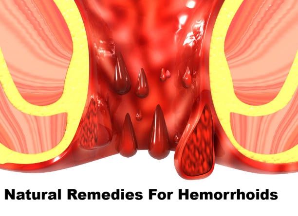 Natural Remedies for Hemorrhoids