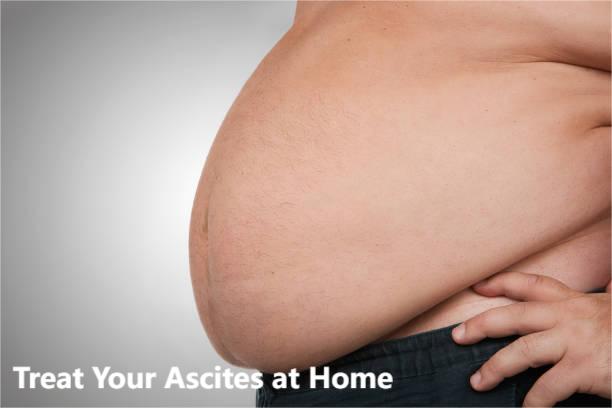 Ascites caused by cirrhosis