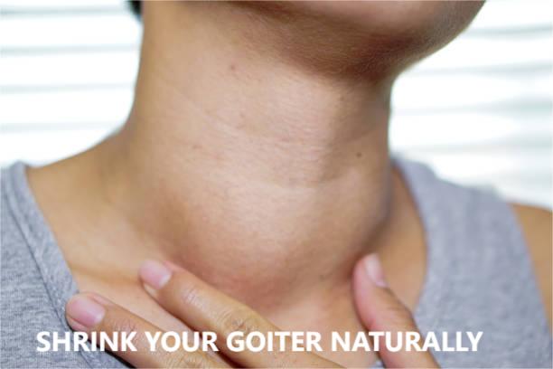 How to Shrink a Goiter Naturally: 10 Proven Remedies Every Woman Should Know