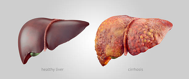 Stage 4 Cirrhosis of the Liver Life Expectancy