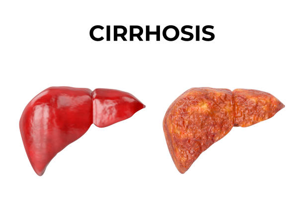 Cirrhosis Symptoms and Treatment: Powerful Strategies for Recovery and Hope