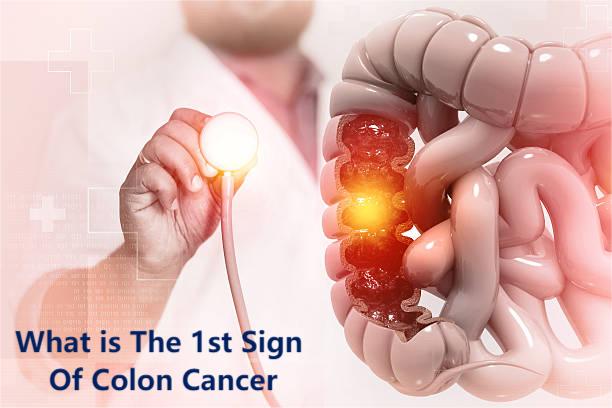 Early Signs of Colon Cancer in Adults: 7 Red Flags That Demand Attention