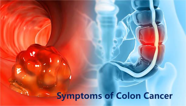 Symptoms of Colon Cancer in Males: 9 Key Symptoms That Need Immediate Attention